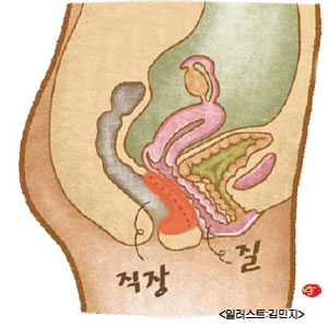 직장질루 변이 앞으로 나와요